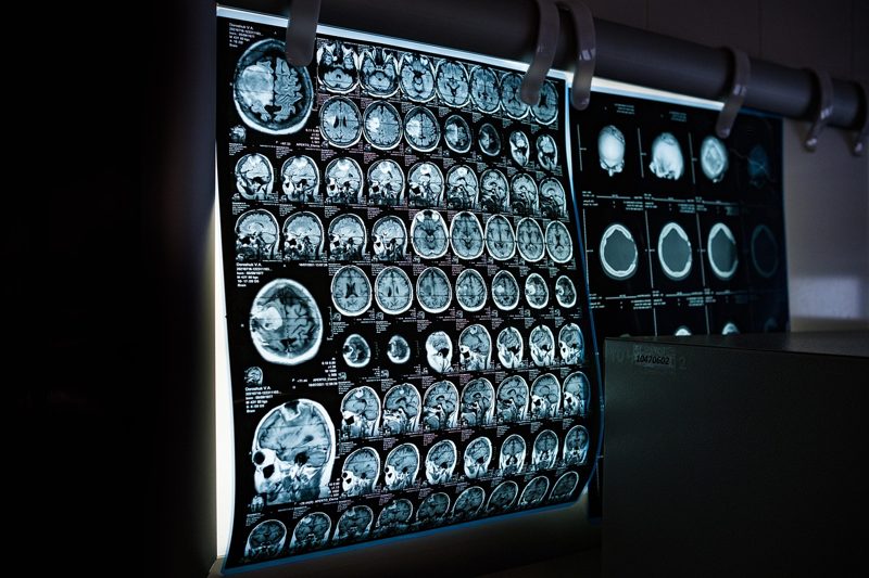 Illustration: Medical X-ray scans of human brains in a hospital room